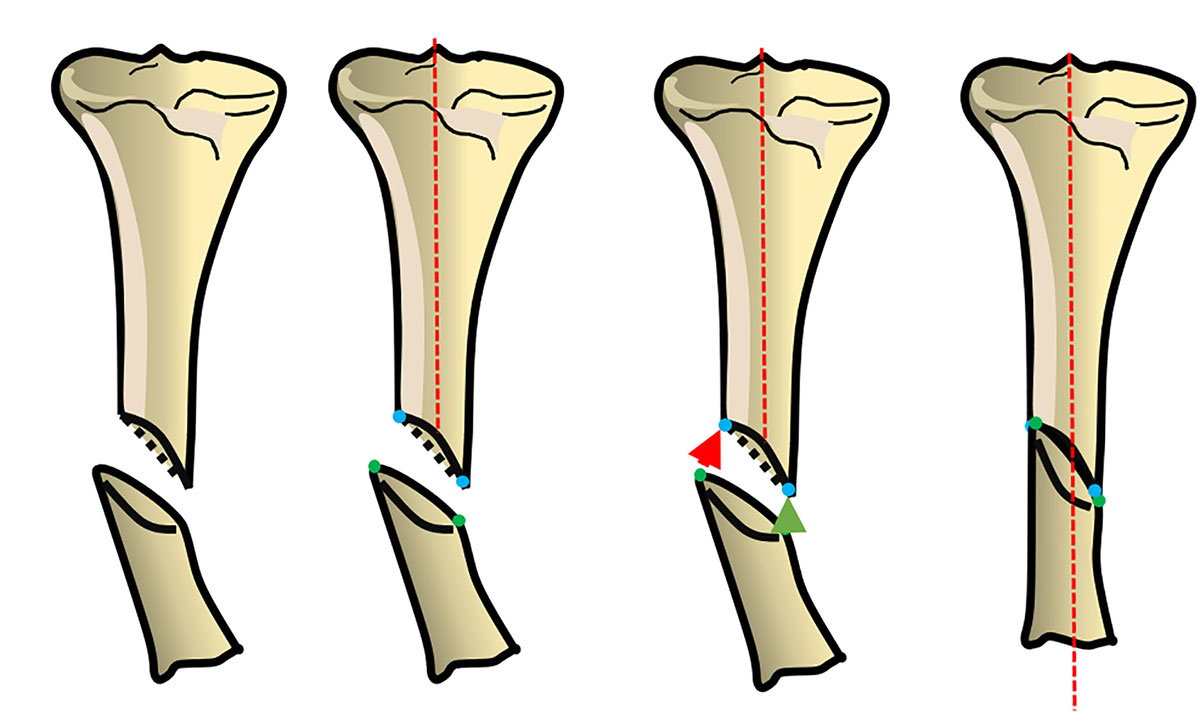 deformity reduction figure 3