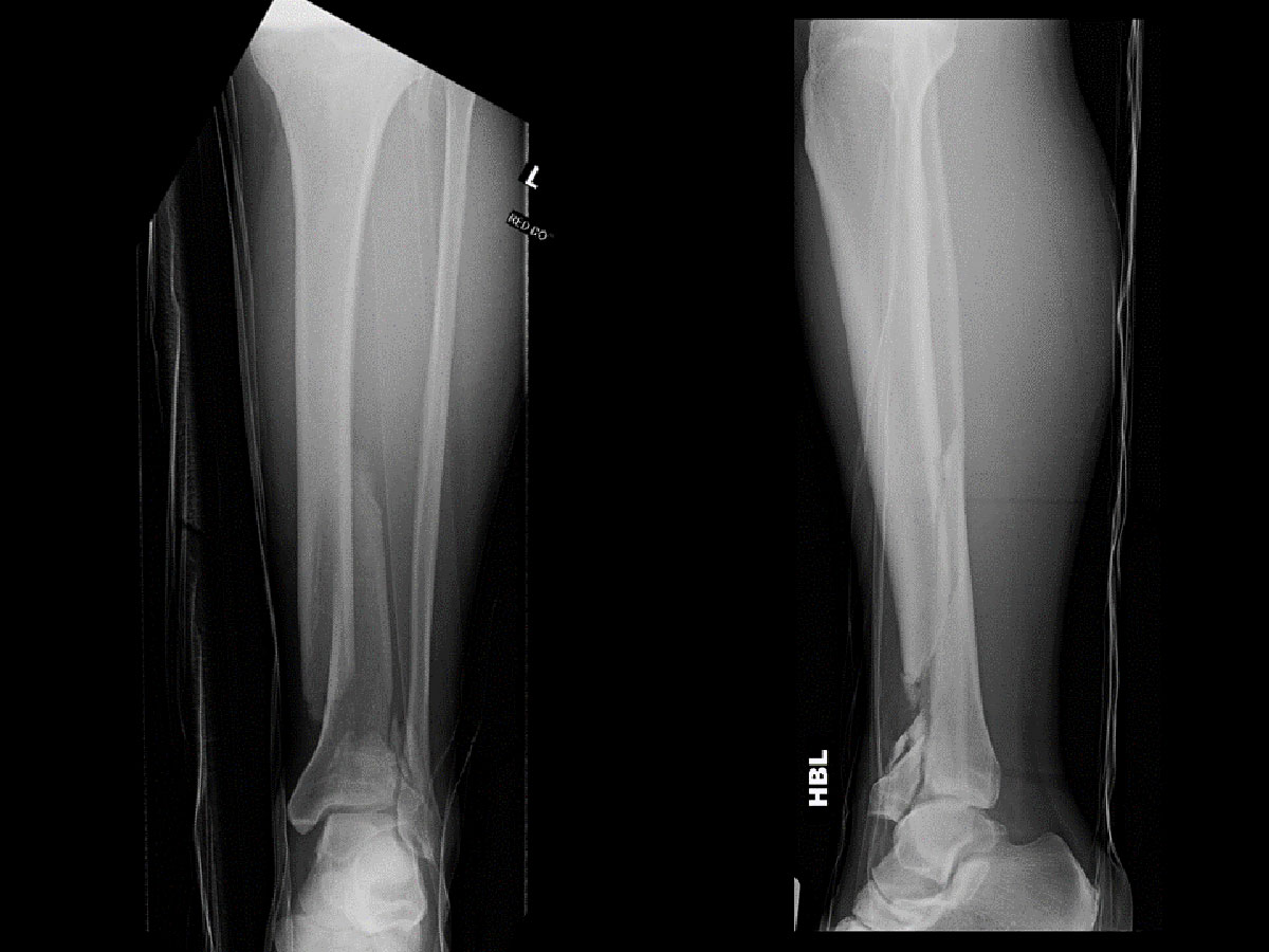 distal tibial fractures figure 1