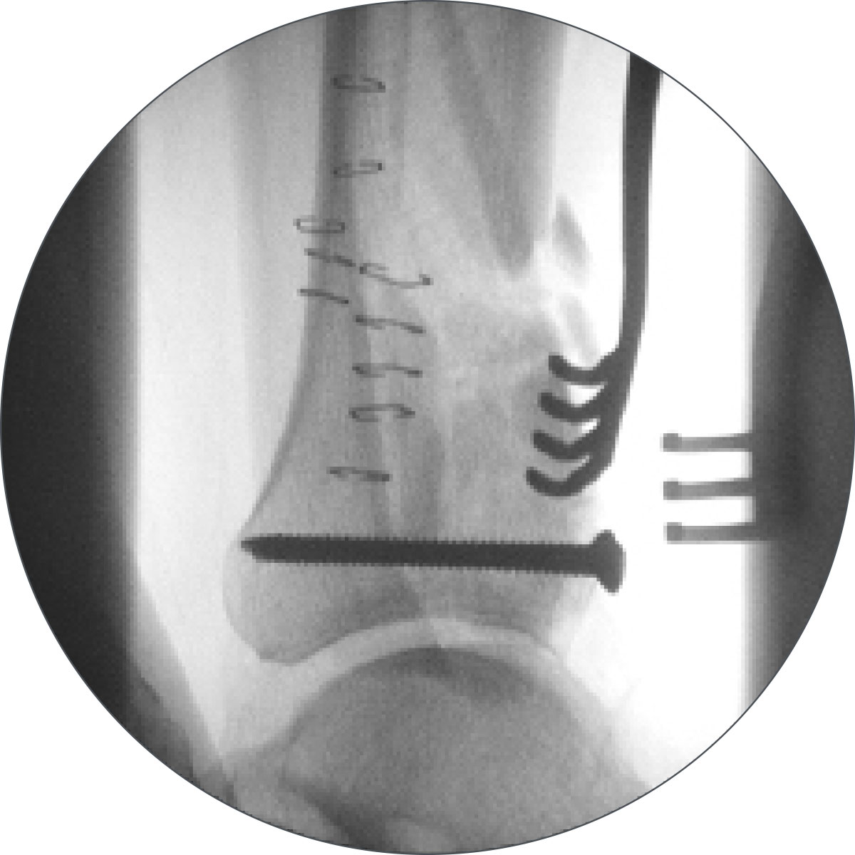 distal tibial fractures figure 2