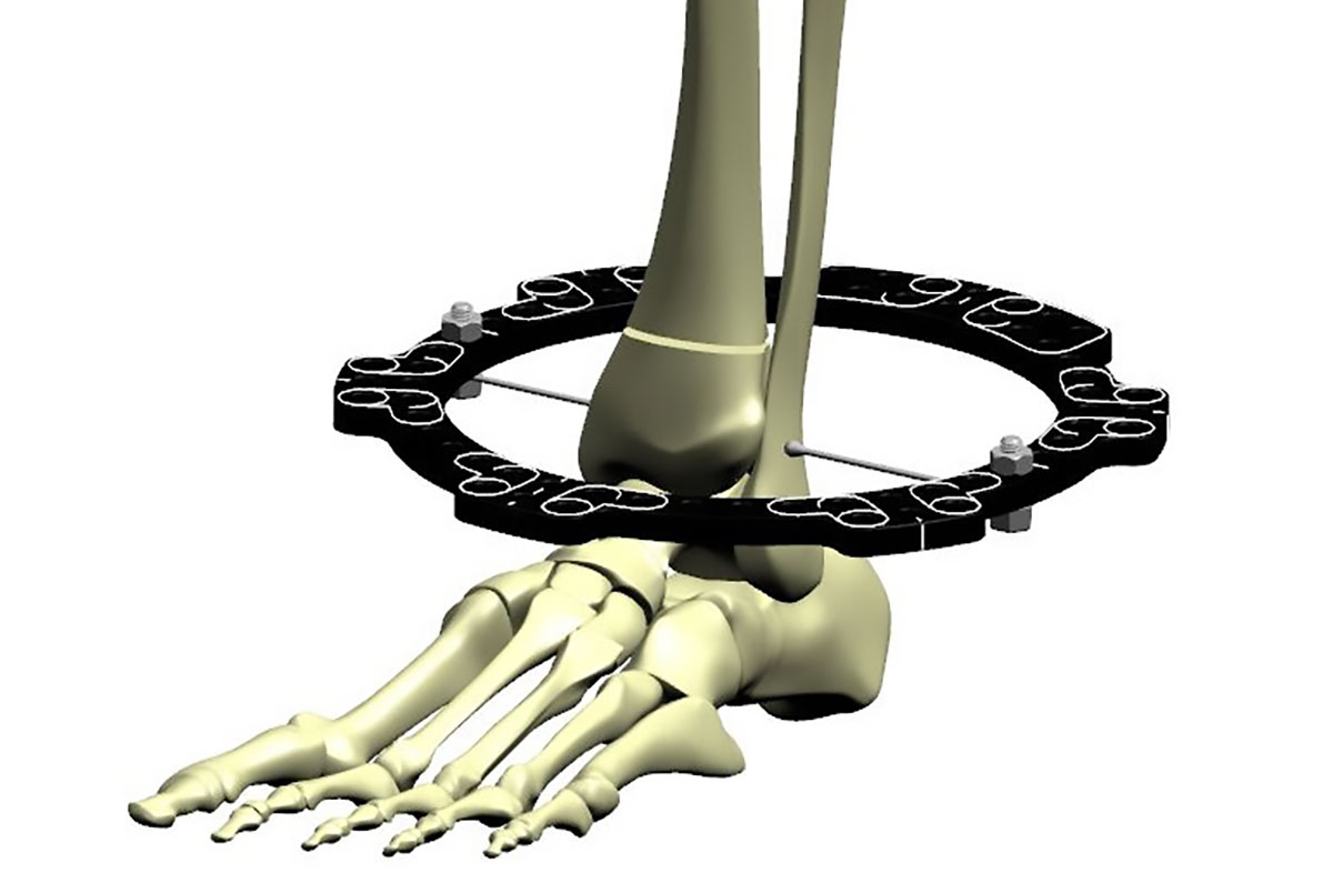 distal tibial fractures figure 3a