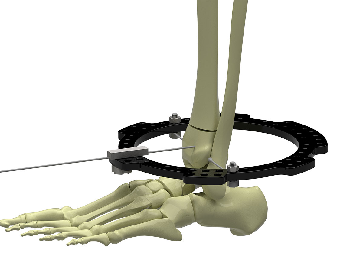 distal tibial fractures figure 3b