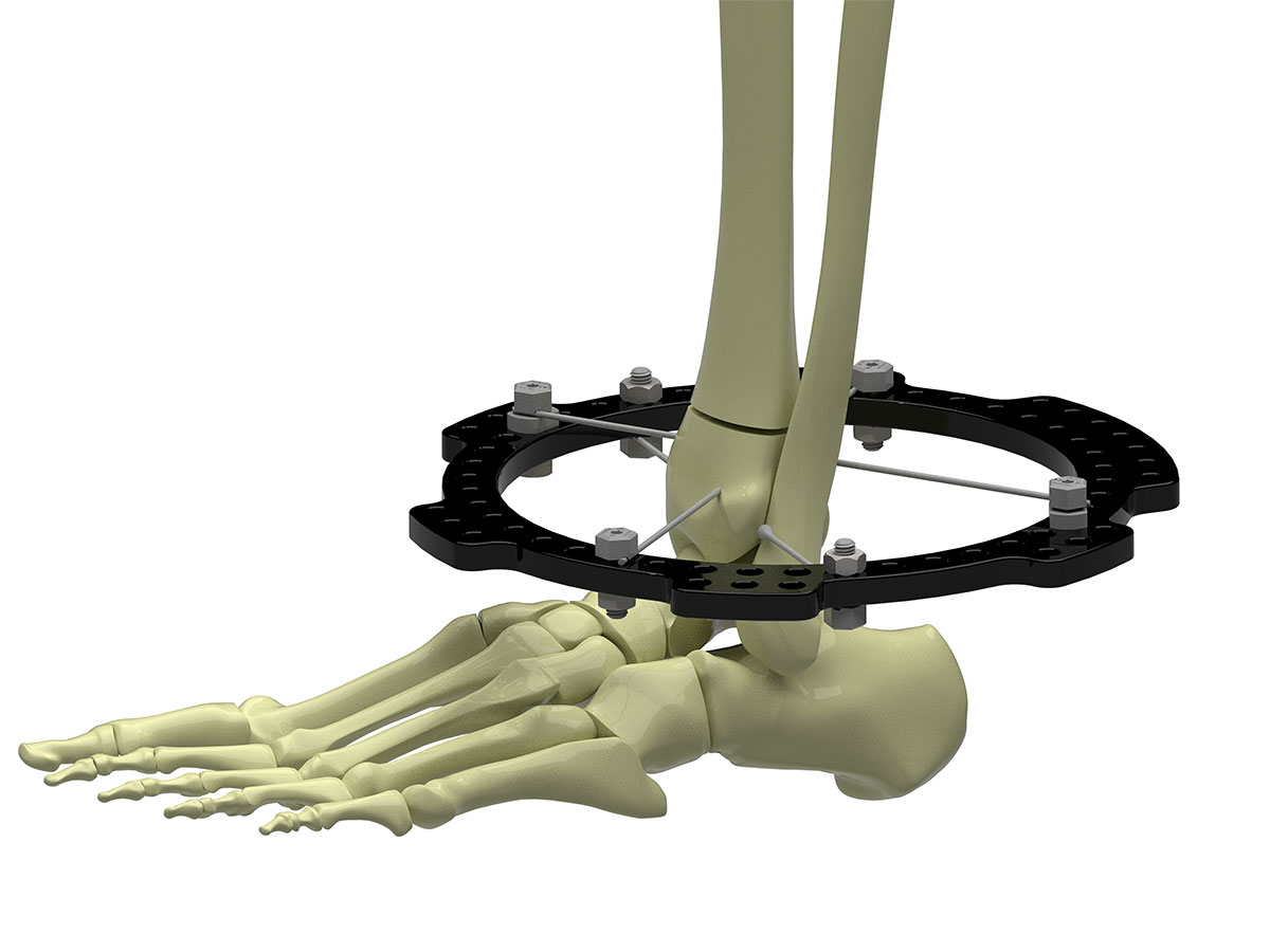 distal tibial fractures figure 3c