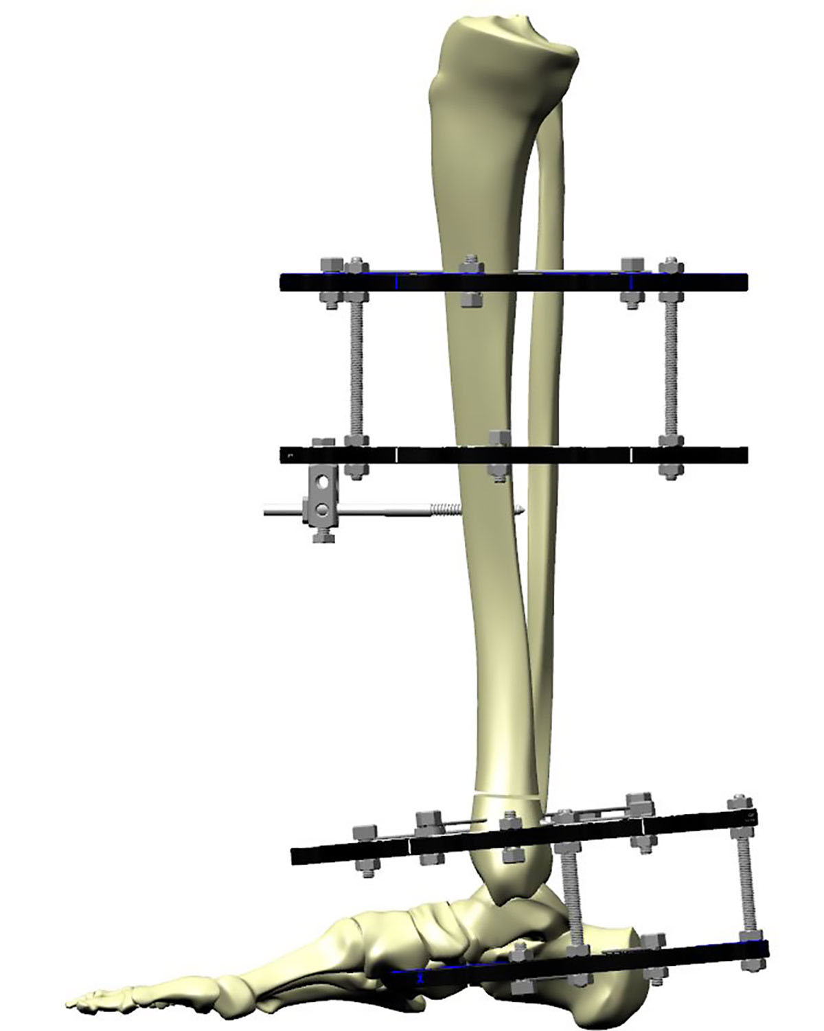 distal tibial fractures figure 4a