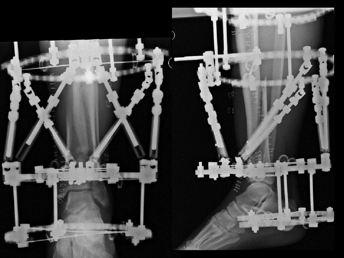 distal tibial fractures figure 5
