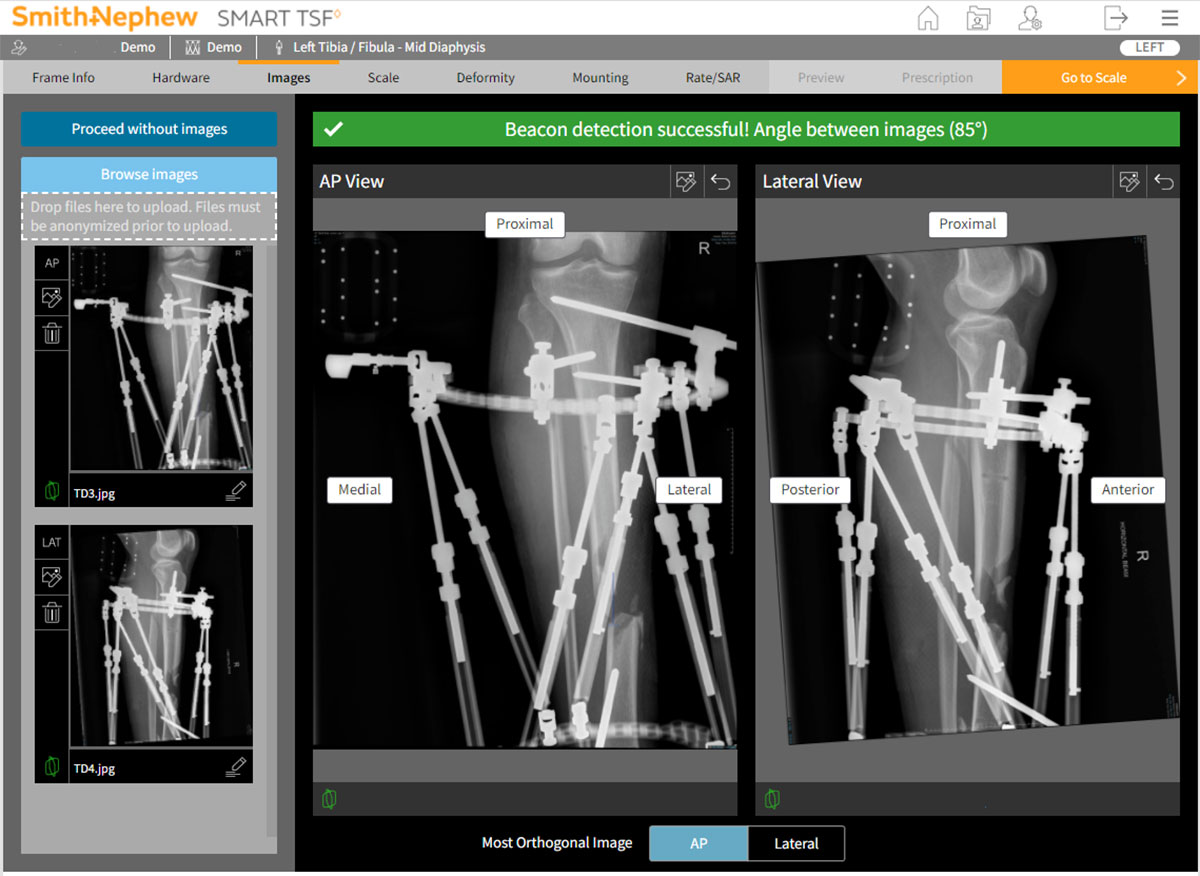 distal tibial fractures figure 6