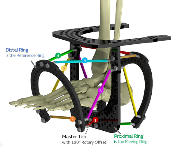 forefoot frame