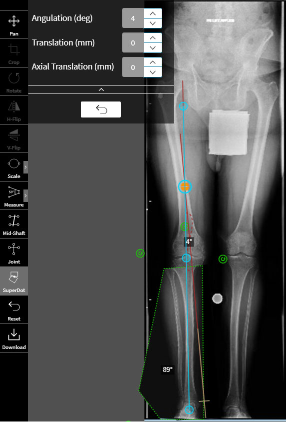 high tibial osteotomy figure 9