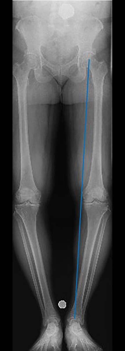 high tibial osteotomy figure 1