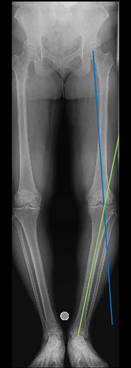 high tibial osteotomy figure 2