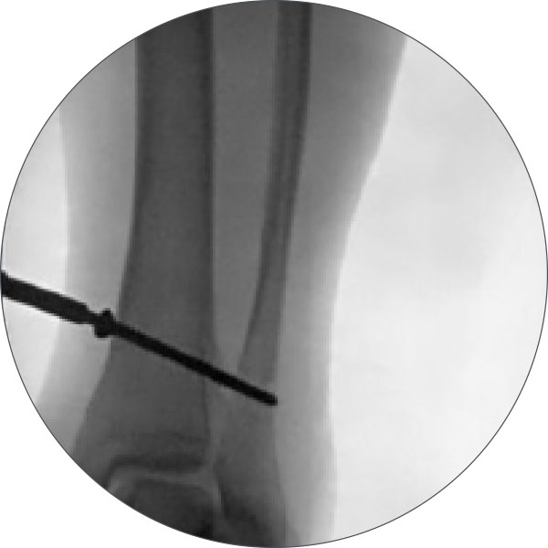 high tibial osteotomy figure 3a