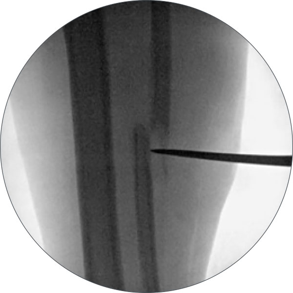 high tibial osteotomy figure 3b