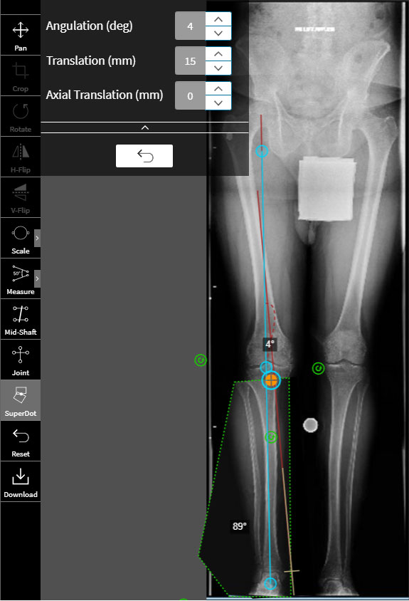 high tibial osteotomy figure 7