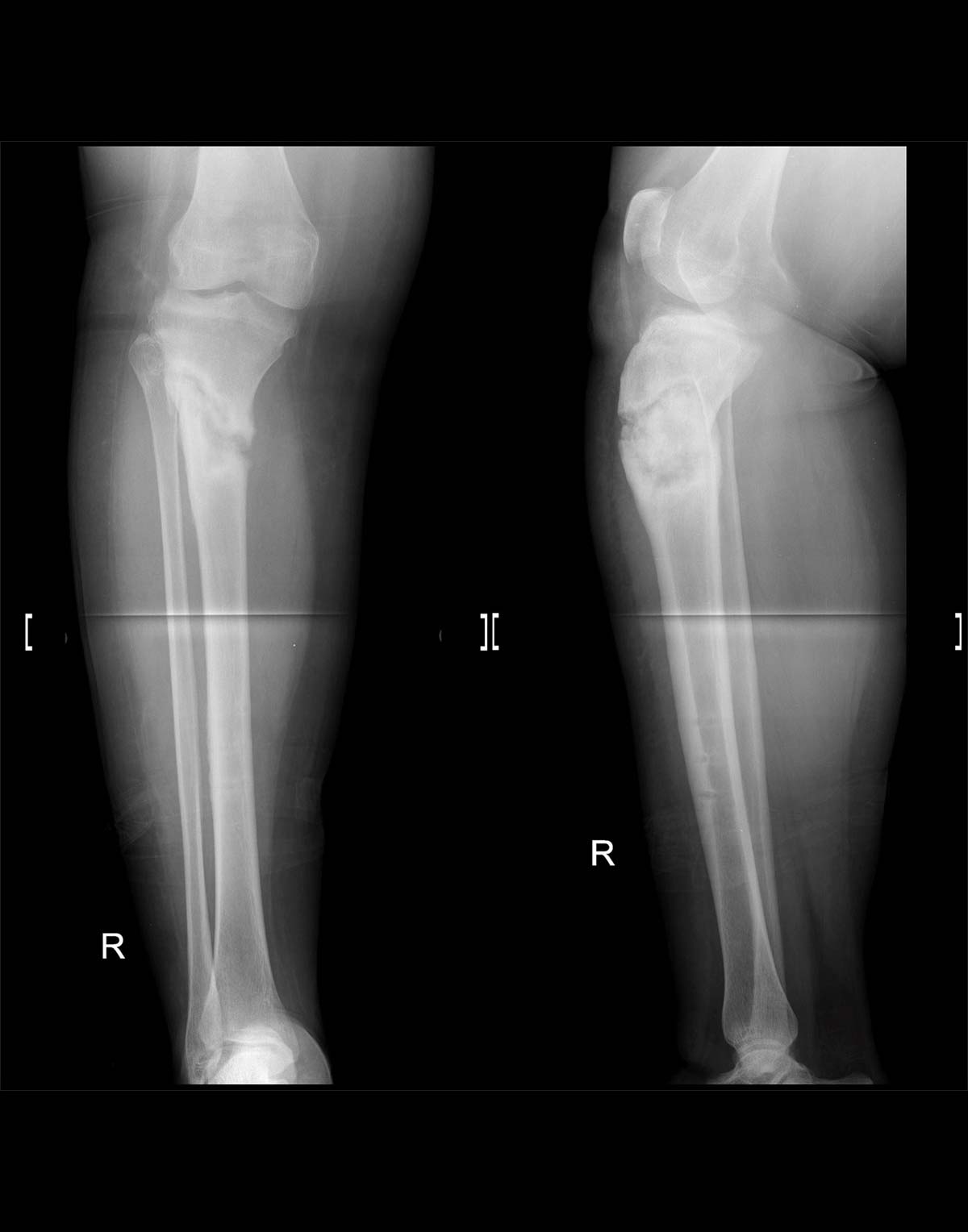 hypertrophic nonunions figure 1a