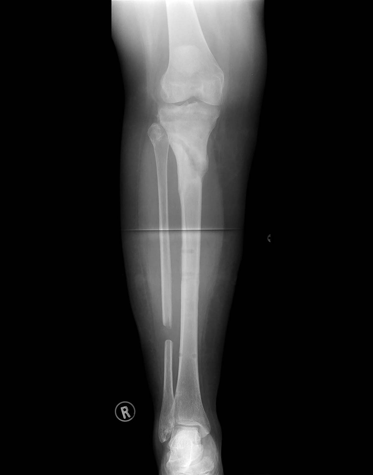 hypertrophic nonunions figure 1c