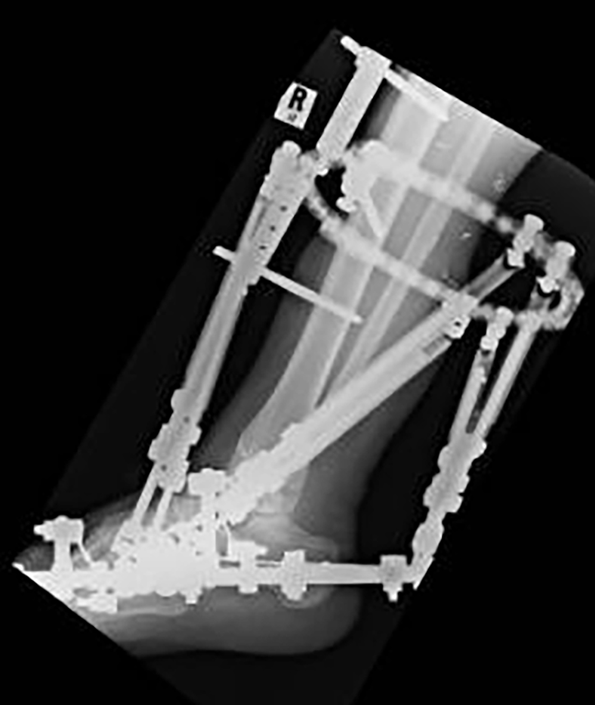 immediately post op 2