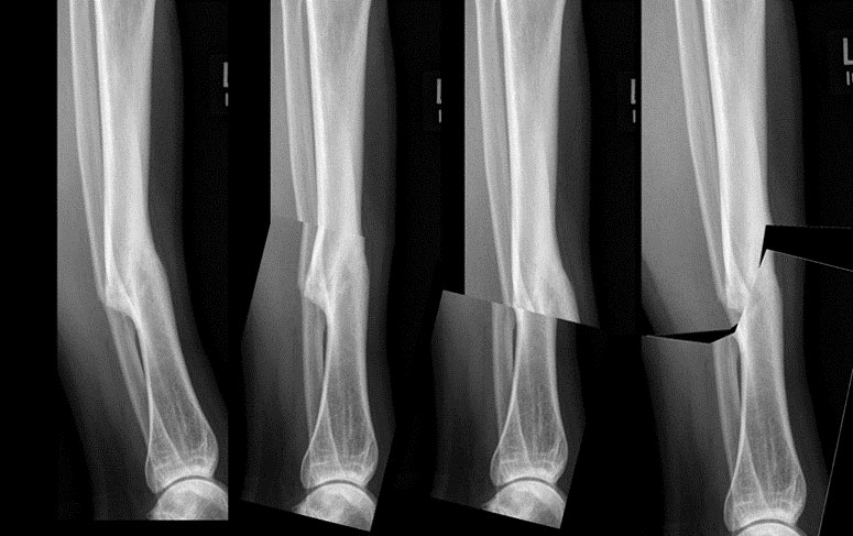 osteotomies