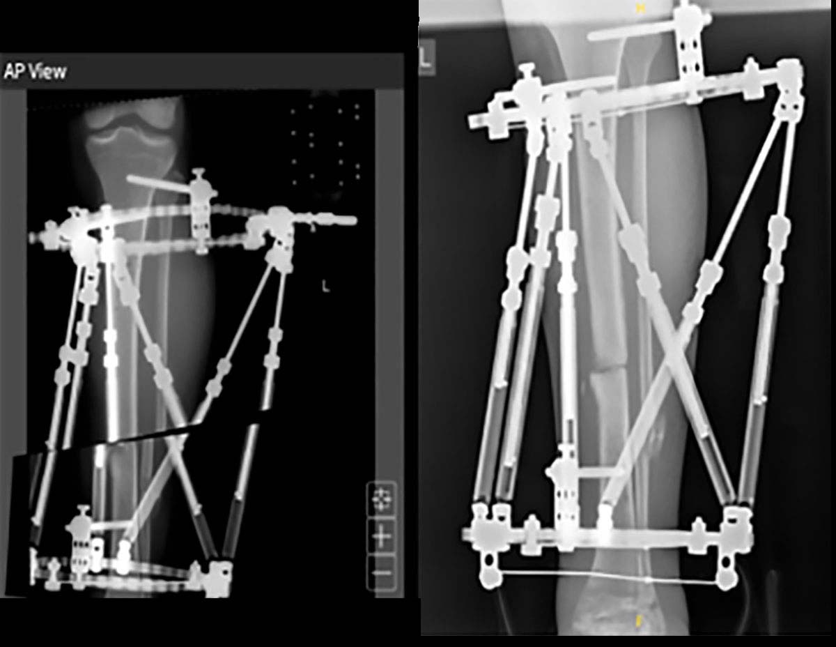 trauma techniques figure 10d