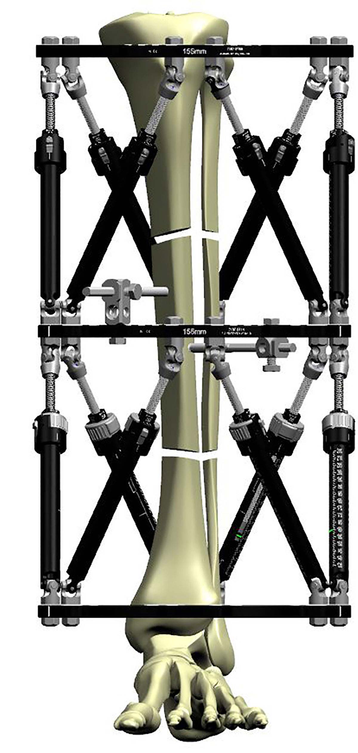 Figure 3a
Segmental fractures fixed with a stacked frame