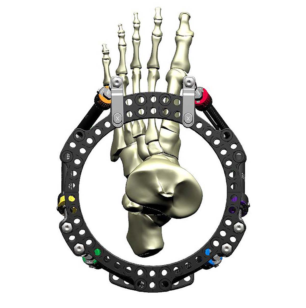 Figure 4b
Top down view showing clearance of Struts from soft tissue