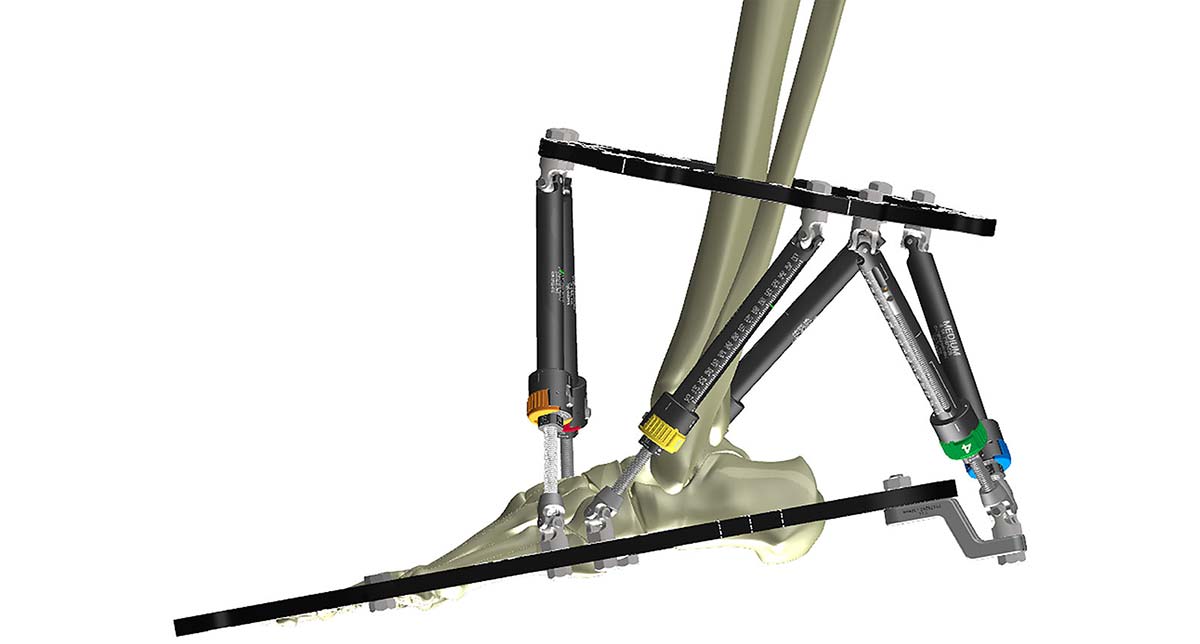 Figure 4d 
30mm Step-Off Plates on Struts 4 and 5 can be removed during correction