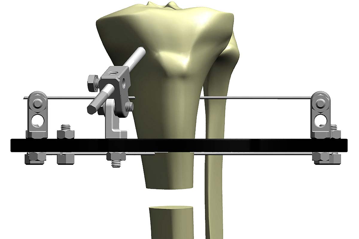 Figure 6b
Proximal fixation optimized with angled pin connector to increase frame stability