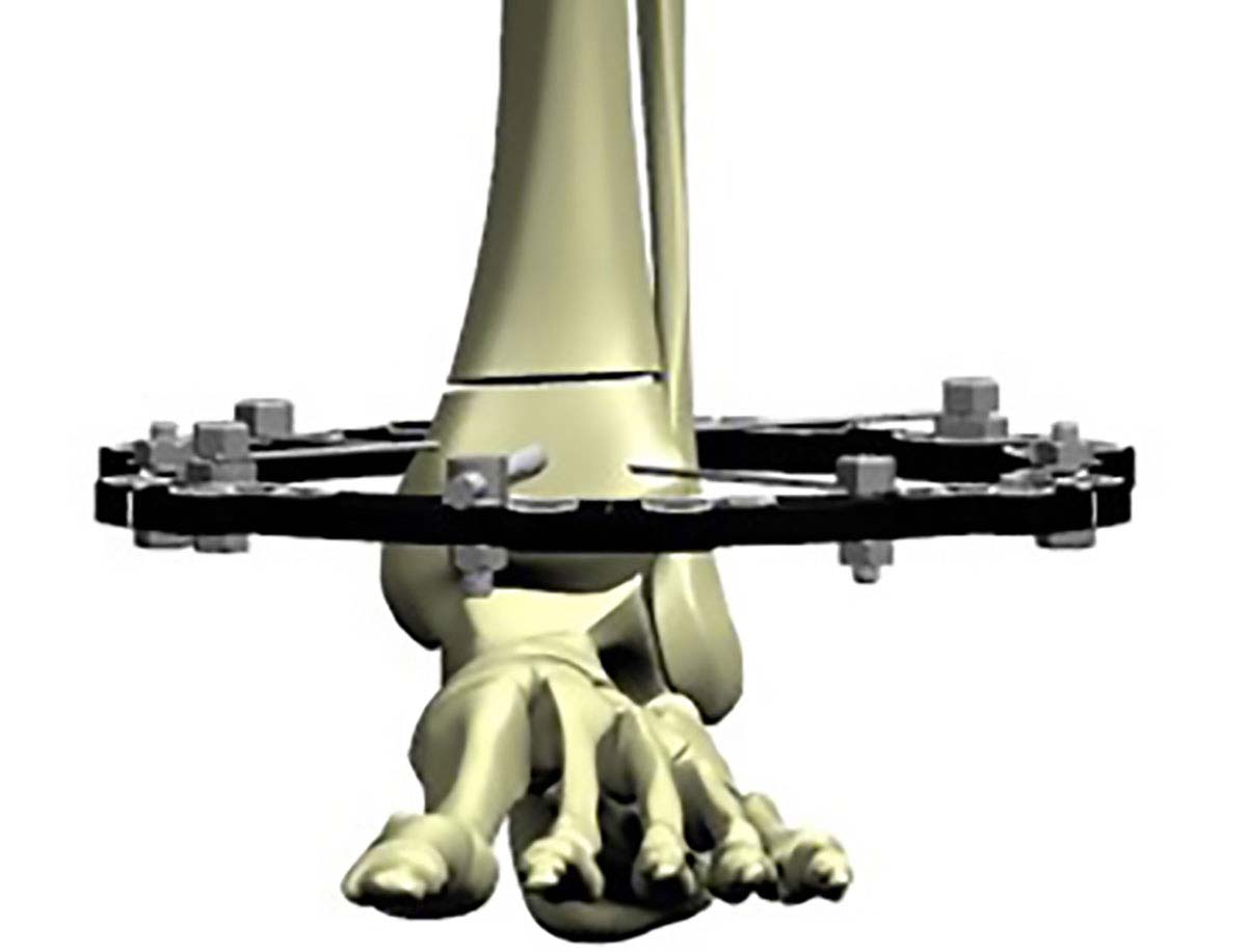 Figure 6c
Use of a half pin in small distal segment fixation can avoid the need to bridge the ankle. 