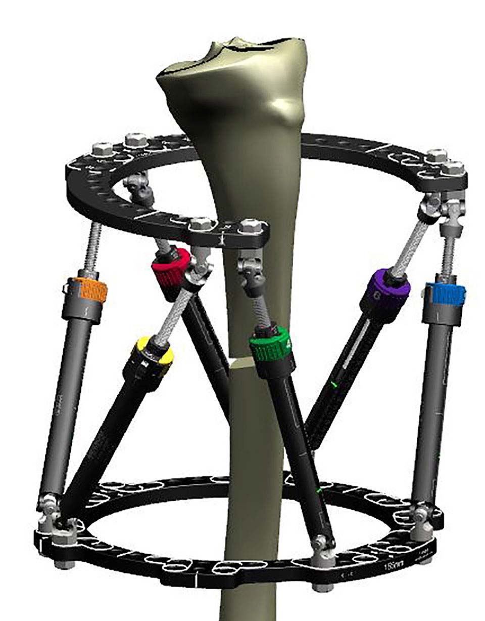 Figure 7a 
Proximal 2/3 Ring with 180º Rotary Offset combined with Custom Strut Mount on the Distal Ring to maximize the window over a wound