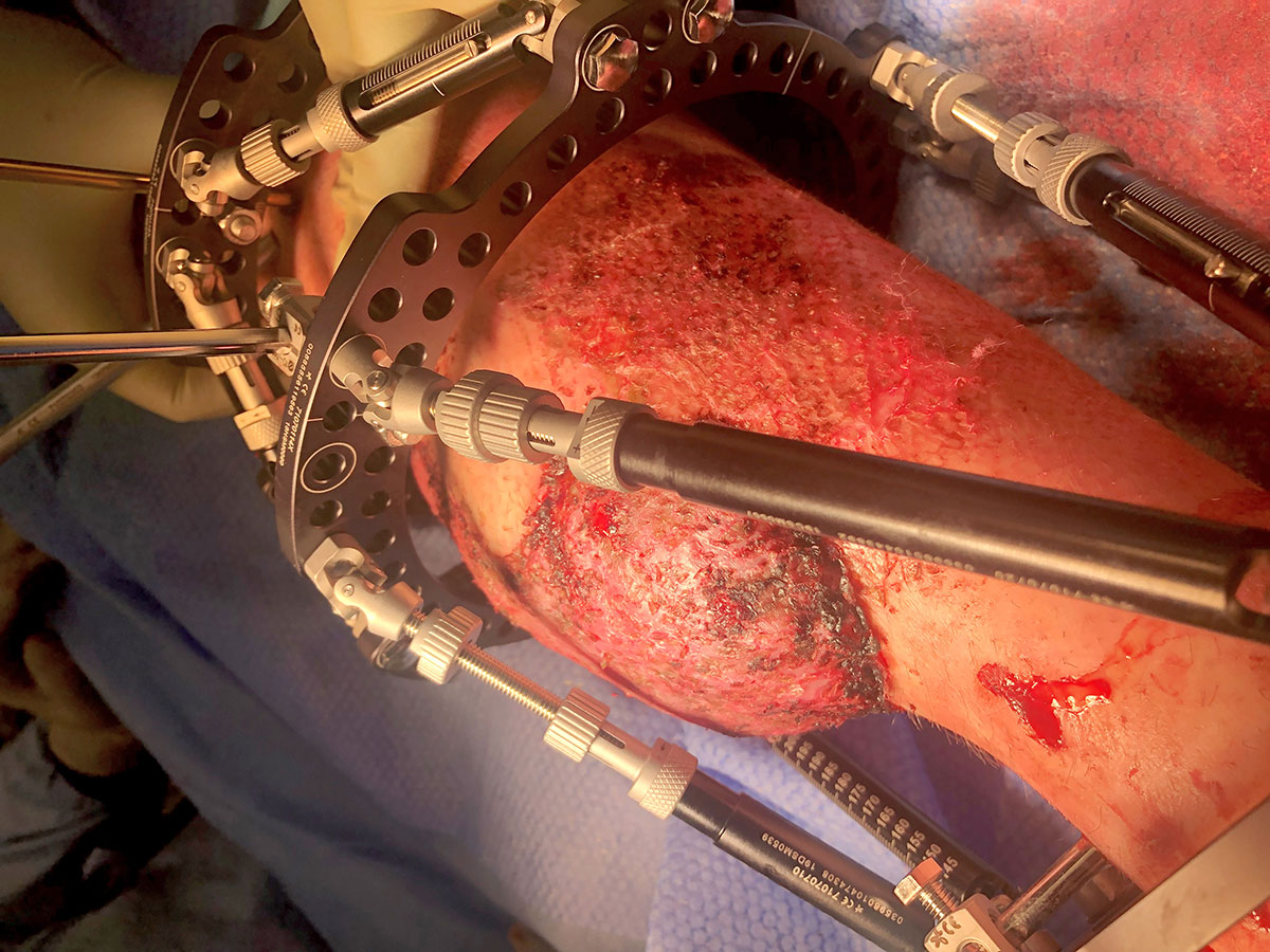 Figure 7b
Custom Strut Mount utilized to avoid impingement on tissue flap