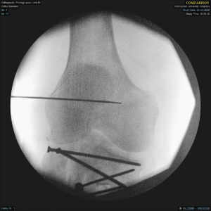 Techniques in Trauma - Compendium of TSF Applications