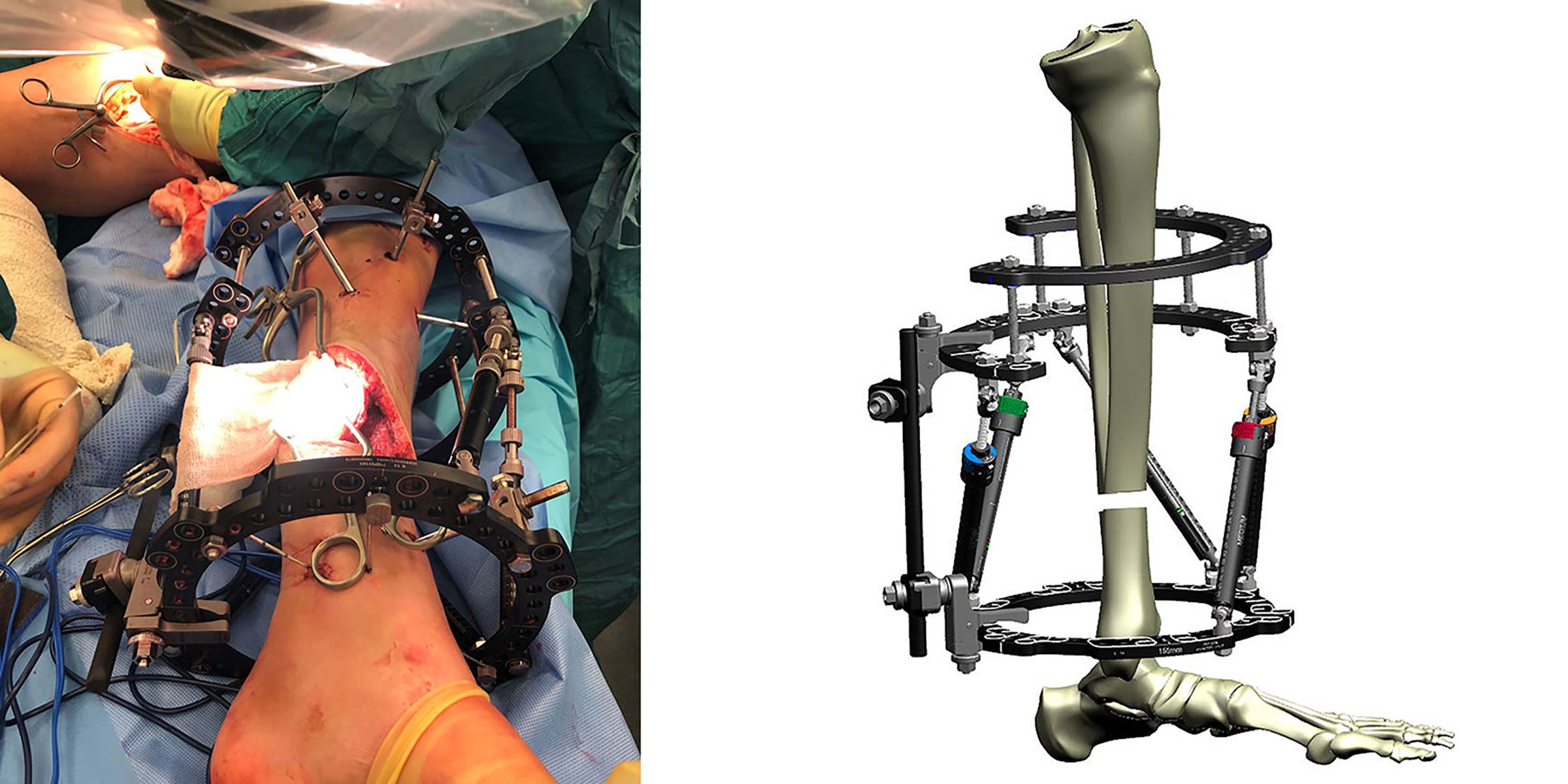 Figures 7d and 7e
Proximal Ring Block using two offset 2/3 Rings allows soft tissue reconstruction. Note Frame Stabilization tool allowing Strut 3 to be removed temporarily 