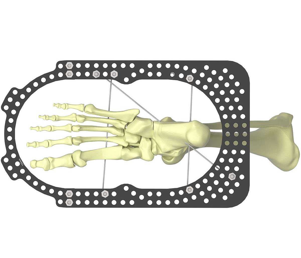 treating equinus figure 2d