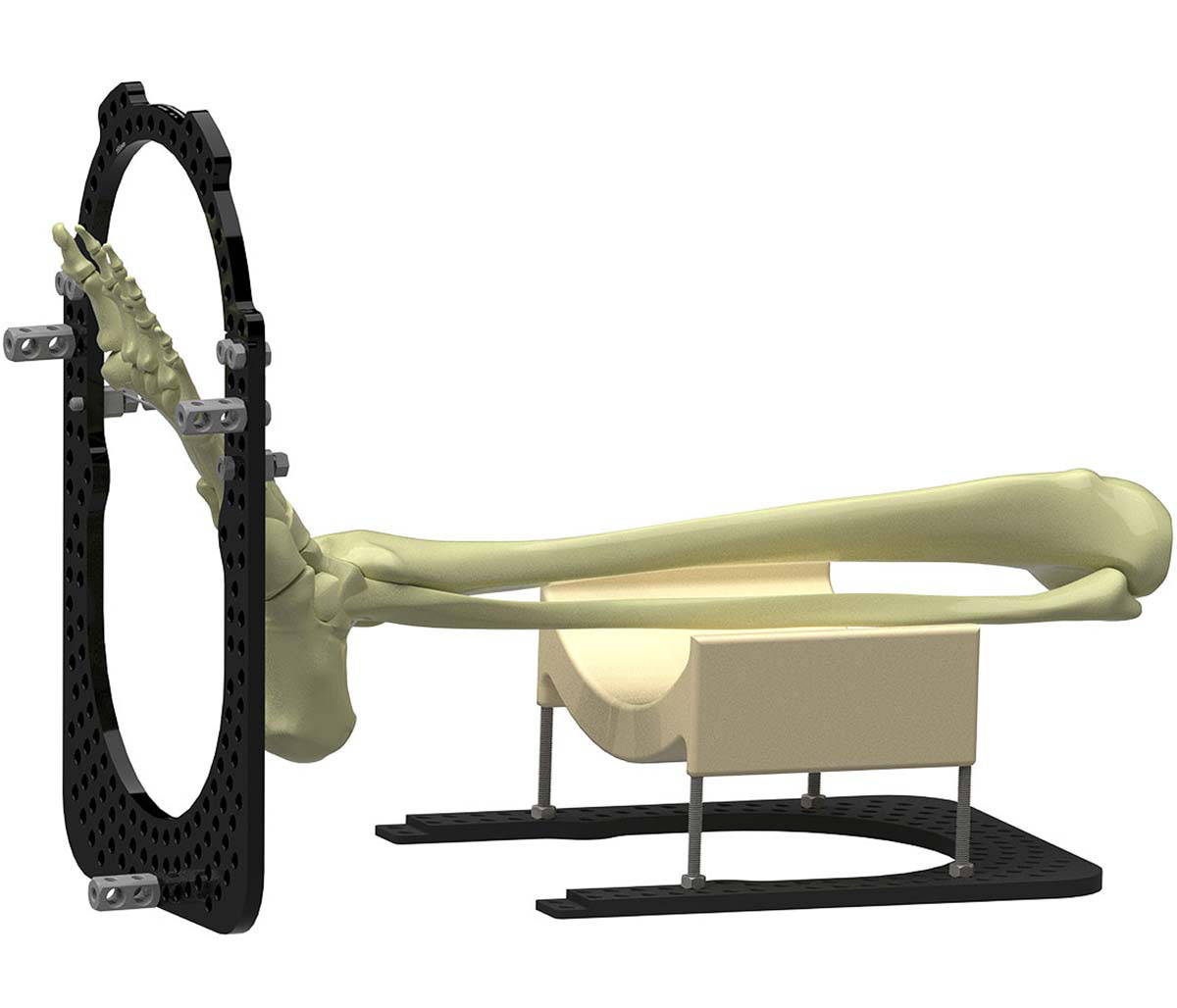treating equinus figure 2b