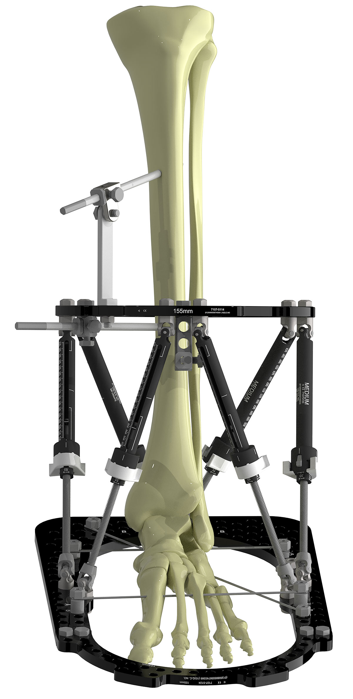 treating equinus figure 3b