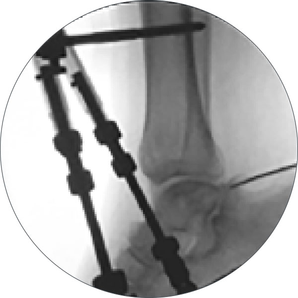 treating equinus figure 4a