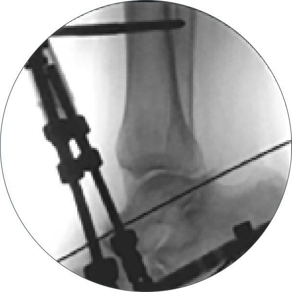 treating equinus figure 4b