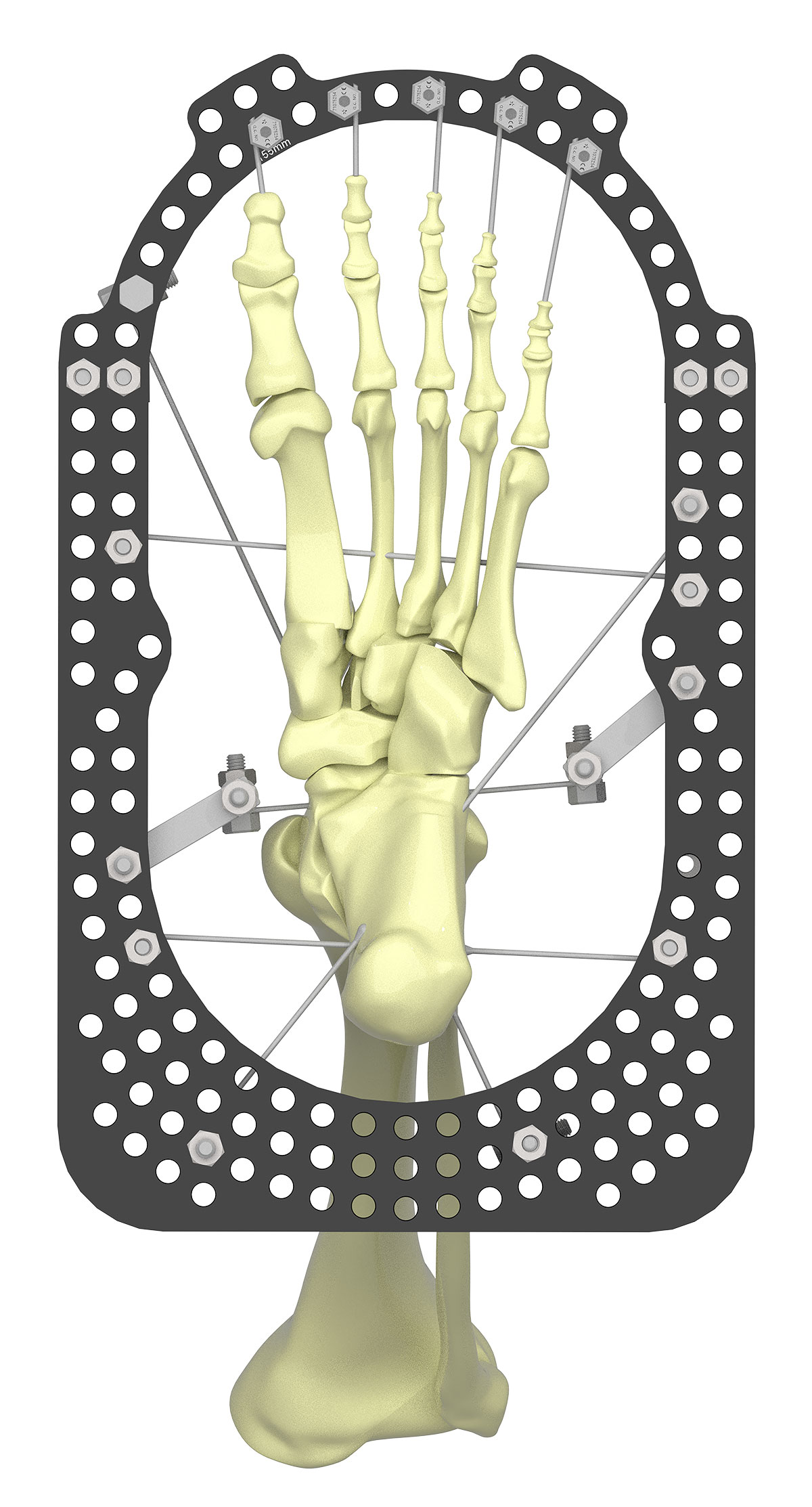 treating equinus figure 6