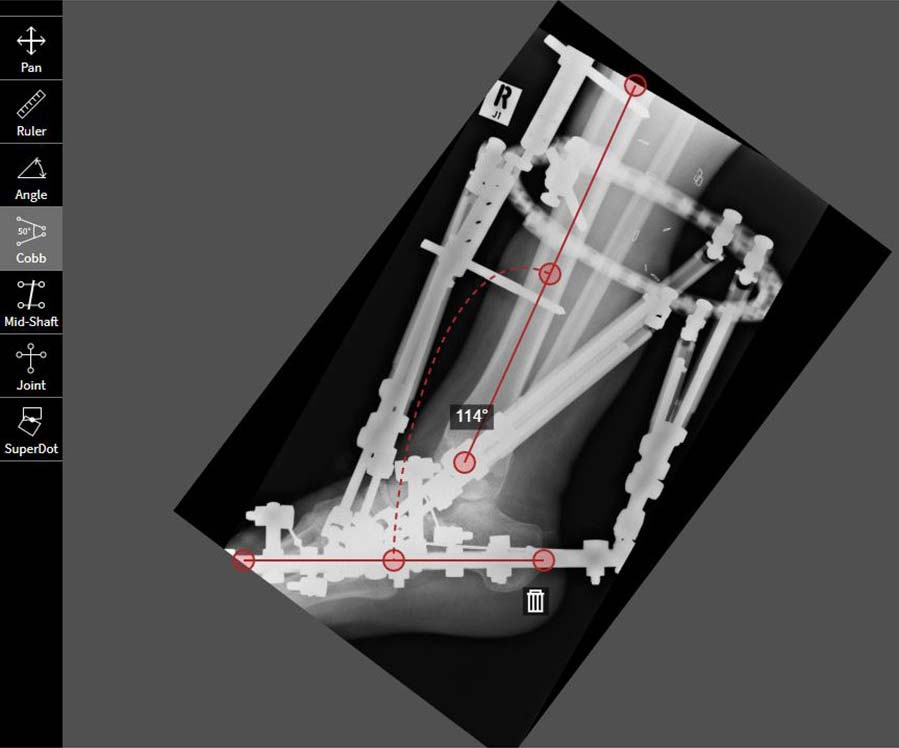treating equinus figure 7a