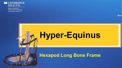 Hyper Equinus Hexapod Long Bone