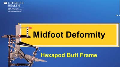 Midfoot Deformity Hexapod Butt Frame