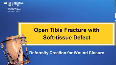 Open Tibia Fracture Soft Tissue Defect