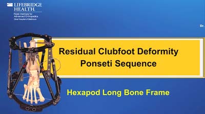 Residual Clubfoot Deformity Ponseti Sequence